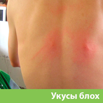 Укусы блох в Новоуральске