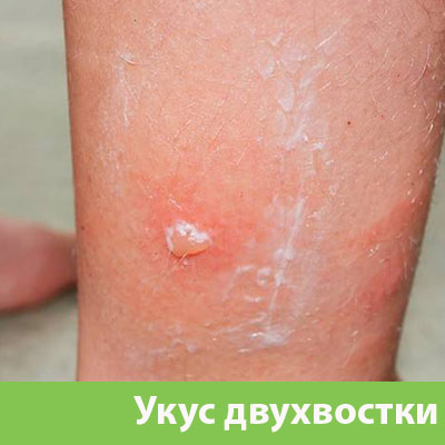 Укус двухвостки в Новоуральске