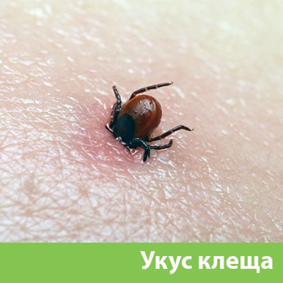Укус клеща в Новоуральске